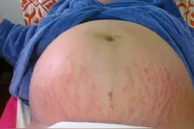 三胞胎孕妇肚子大的似透明建议马上剖腹产，看到宝宝性别全家乐了图片