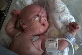 早产儿先天肠子在身体外 3次战胜死亡生还图片