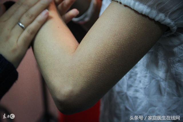 为什么特别热的时候起鸡皮疙瘩