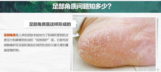 辨证治疗绝经期掌跖角化综合征
