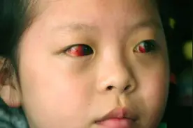 4岁女孩看电视致半失明，而造成的后果还不仅这样，家长追悔莫及视频封面