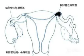 输卵管堵塞跟排卵有没有关系？图片
