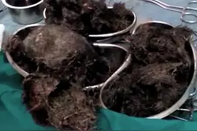 印度一少女胃中取出近2斤毛球 因长期吞食头发图片