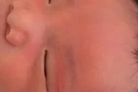 What！用针能给BB划出双眼皮？图片