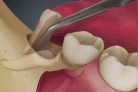 医学3D动画演示：智齿去除手术全过程，看的牙疼