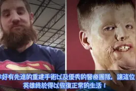 美国军人为救朋友，被一万伏高压电击中毁容，如今的模样让人落泪视频封面