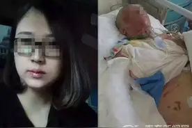 遭遇天然气爆炸事故 阆中女子被烧前后判若两人图片
