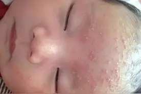 宝宝湿疹痒起来好痛苦|一个皮肤科医生爸爸实战经验告诉你咋办？图片