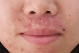 粉刺痘痘知多少？教你彻底告别痘痘！图片