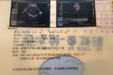 每一项指标都不能顺产，孕妈却想坚持！值吗？图片