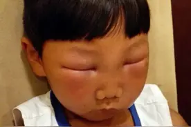 宝宝郊游后，第二天脸肿的像馒头，妈妈哭笑不得图片