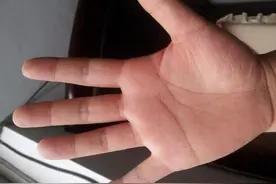 身体出现这3种表现，可能是肝脏出了问题图片