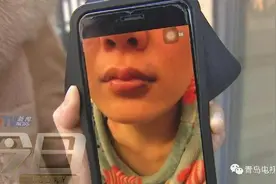 青岛：女子注射玻尿酸嘴唇又歪又肿 索赔遇难题图片