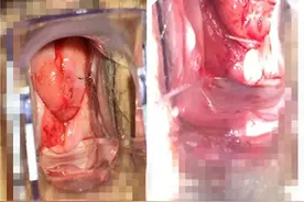 LEEP术说一二图片