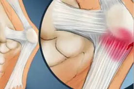 疾病百科丨跟腱断裂最简单的诊断方法图片