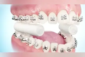 为什么做个牙套花费3000多，看完箍牙过程，你就明白了