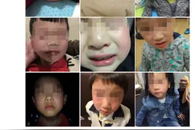 杭州某幼儿园教室紫外线灯没关，多位小朋友眼睛被灼伤、突发高烧！图片