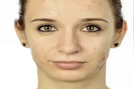 内分泌失调为什么会长痘？该如何处理？图片