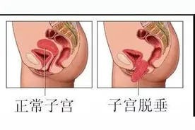 产后束腹带并非“美体带”  勒得过紧甚至可能引起子宫脱垂图片