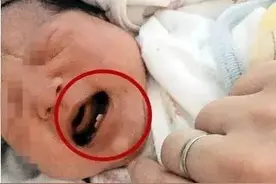 宝宝一出娘胎就有牙 “鬼牙”让爸妈好担心 医生提醒：“诞生牙”过于松动应拔掉图片