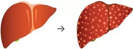 肝病全营养配方食品设计思路