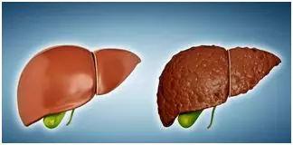 肝病全营养配方食品设计思路