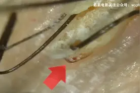 你也一定有同感 头皮硬结角质在放大镜头下取出 看完舒服啊！视频封面