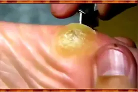 你脚底会生茧子么？这样的硬皮长在脚底走路都疼 娴熟刀法去除掉