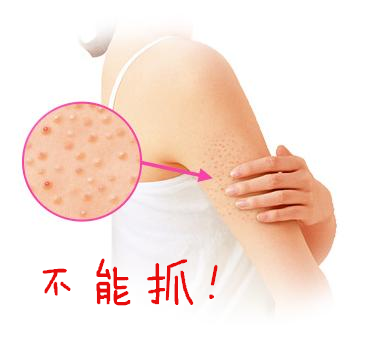 女生大腿根部鸡皮疙瘩