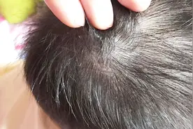 头皮屑大块能扣下来吗？该如何治疗呢？