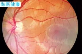 视网膜脱落的术后护理要注意这几点，禁忌事项早知道早预防！视频封面