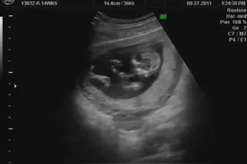 孕妇b超检查图像，这是男孩还是女孩？