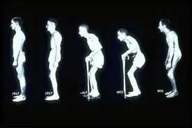 强直性脊柱炎的定义、诊断及治疗知识普及图片