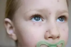 面部敏感微红？反复发作的激素依赖性皮炎到底该怎么破图片