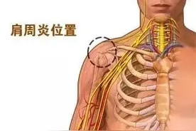 [骨健奇谈]夏季预防肩周炎注意这些关键点图片