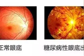 你知道吗？检查眼底就能发现这4大常见疾病图片