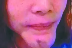 打了一针后 她的下巴不停长不停长图片