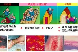 病患管理老年糖尿病皮肤破损的无痂愈合图片