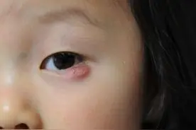 到底看什么了，得了针眼图片