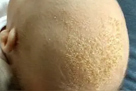 新生儿囟门有好多胎垢，妈妈说是天生的，不可以洗，这是真的吗？图片