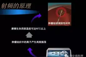 消融，肝脏肿瘤的微创治疗图片