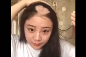 “电钻吃玉米女孩” 的头发不能长出来吗？图片