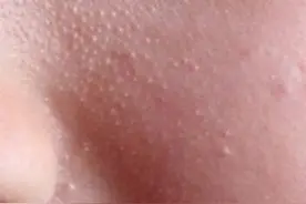 爱吃油腻食物 长了油脂粒怎么去掉？图片