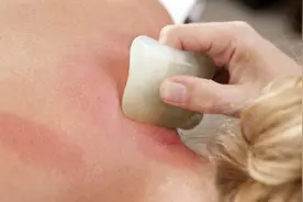 刮痧有讲究 孕妇体虚者不适宜图片