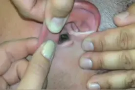 耳朵跑进一只飞蛾，朋友赶紧用镊子帮他取出来