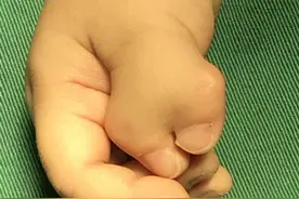 蟹钳样多指，切了就万事大吉？！图片