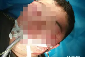 河北医大二院多科联动成功救治钢筋穿头患者图片
