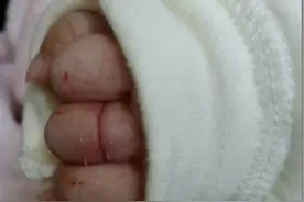 这个细节父母要注意！妈妈一根头发，差点缠断婴儿手指图片