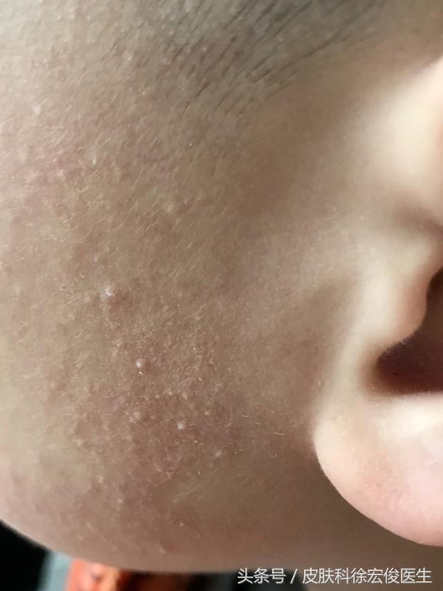 鸡皮疙瘩抹尿素霜管用吗