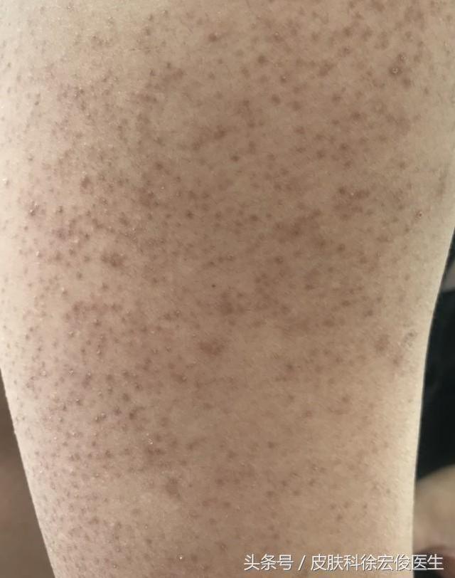 鸡皮疙瘩抹尿素霜管用吗